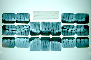 顎関節チェック